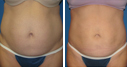 Before & After Photos
